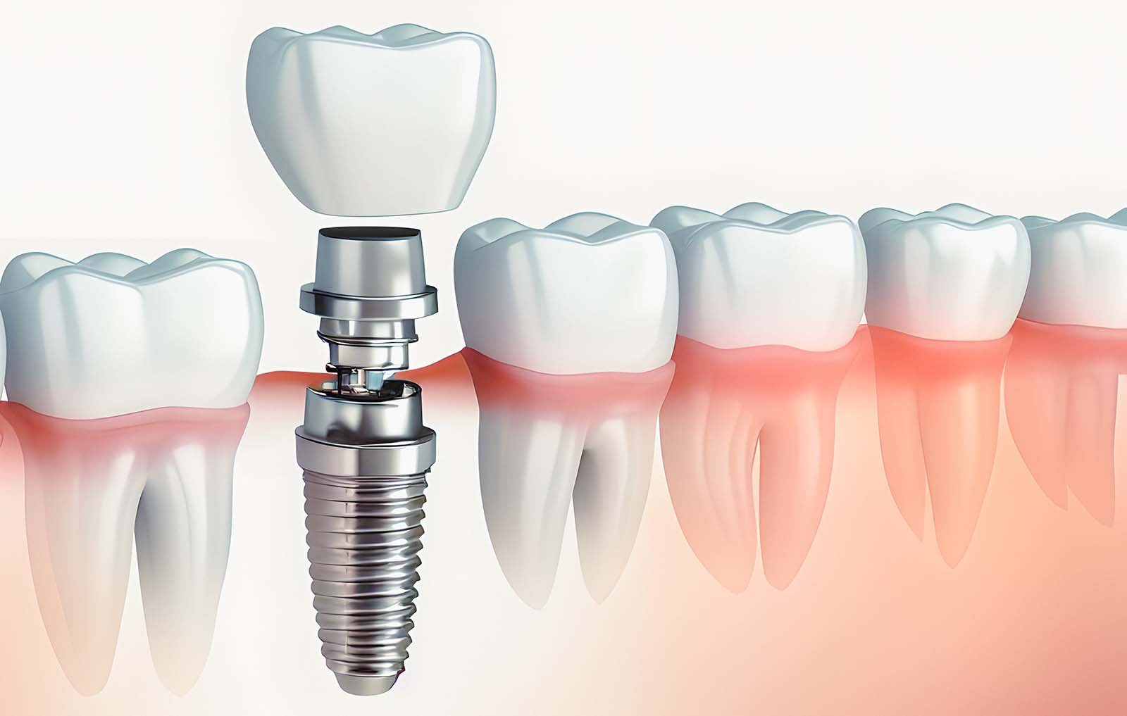 $399 dental implants