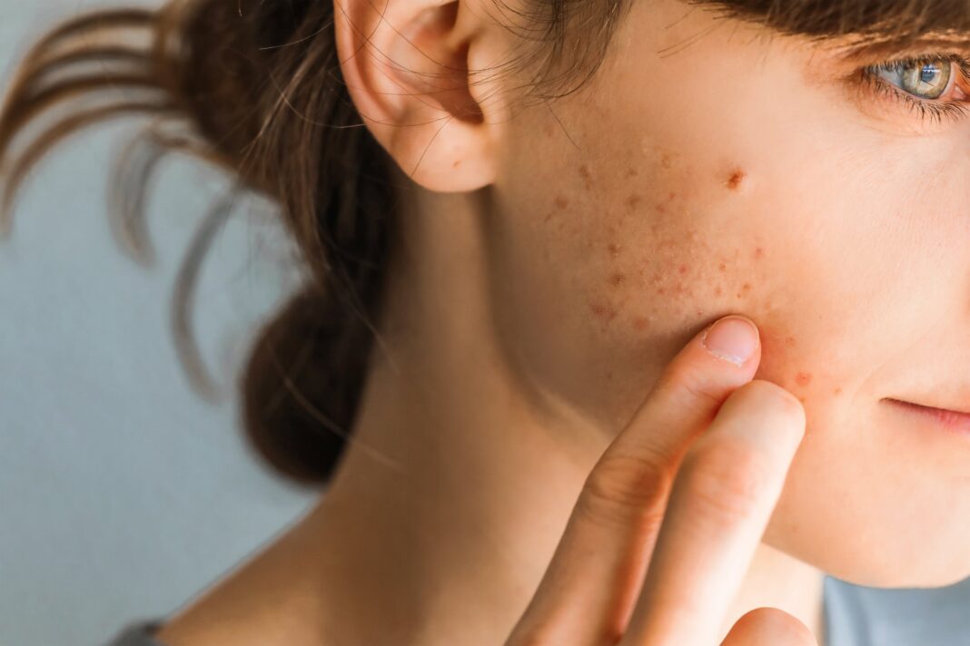 5 Simple Habits to Help Address Your Acne Problems