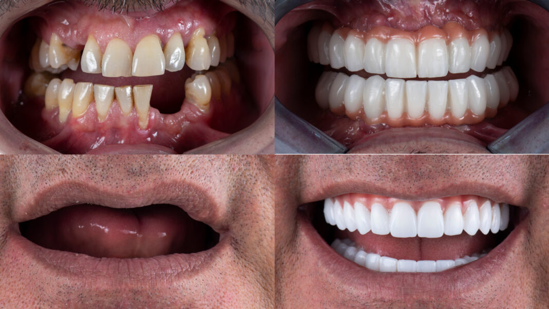 How to Know if You Need a Single Implant or Full-Mouth Restoration