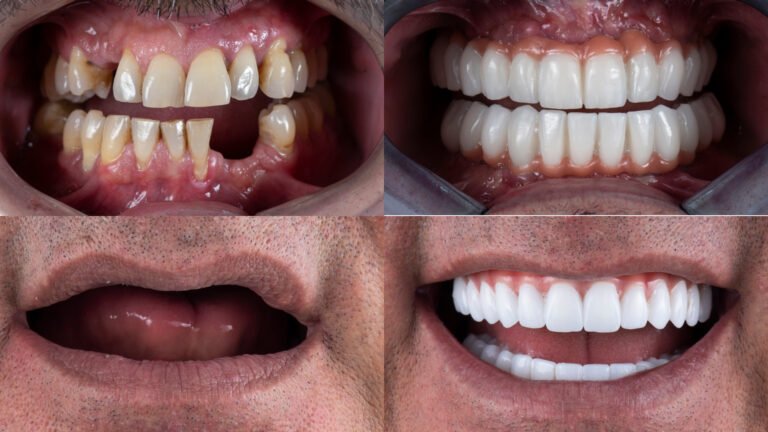 How to Know if You Need a Single Implant or Full-Mouth Restoration