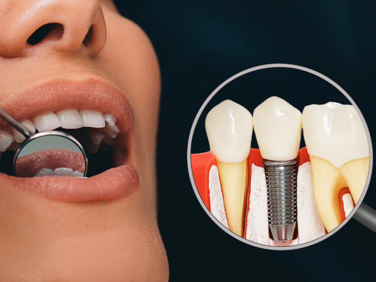 How Safe Are Dental Implants for Patients With Chronic Conditions?