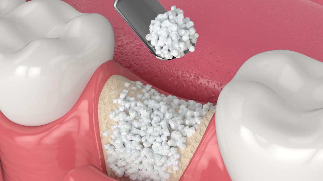How Bone Grafting Works Before Dental Implants
