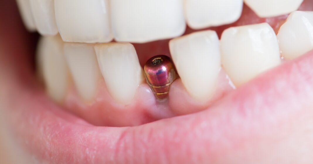 How Painful is Getting a Dental Implant?