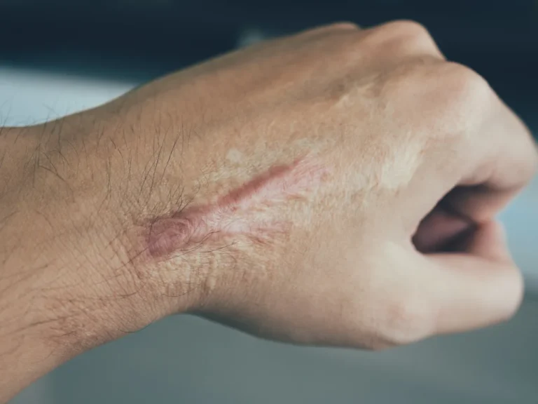 Keloids Explained: Understanding Their Development and Care