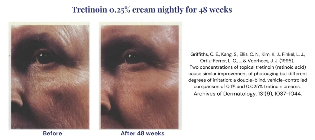 Tretinoin Before After: The Definitive 2025 Guide to Realistic Results